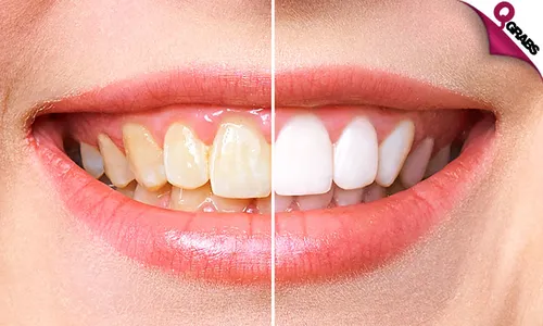 Teeth Whitening + Consultation!